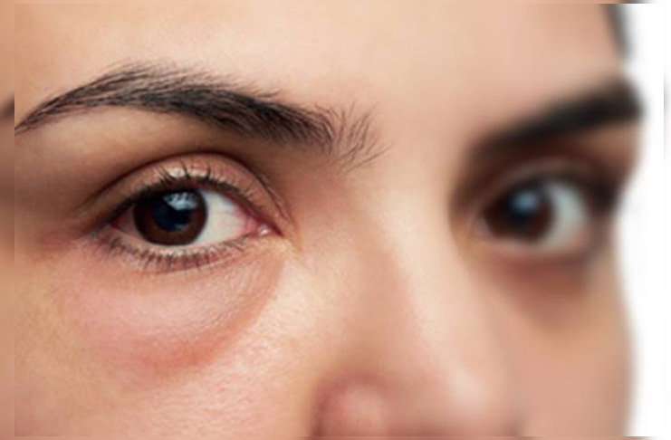 4 Tips Mudah Menghilangkan Kantong Mata